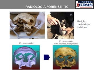 RADIOLOGIA FORENSE - TC
 