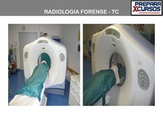 RADIOLOGIA FORENSE - TC
 
