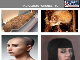 RADIOLOGIA FORENSE - TC
 