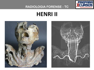 RADIOLOGIA FORENSE - TC
HENRI II
 