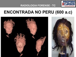 RADIOLOGIA FORENSE - TC
ENCONTRADA NO PERU (600 a.c)
 