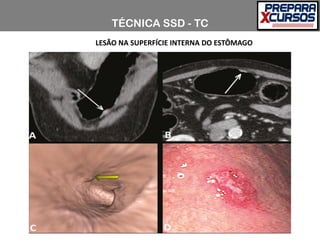 TÉCNICA SSD - TC
LESÃO NA SUPERFÍCIE INTERNA DO ESTÔMAGO
 