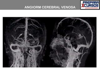 ANGIORM CEREBRAL VENOSA
 