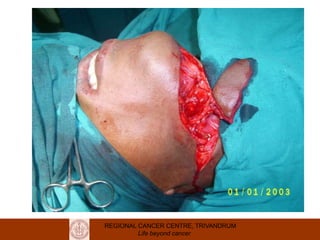 REGIONAL CANCER CENTRE, TRIVANDRUM
Life beyond cancer
 