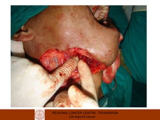 REGIONAL CANCER CENTRE, TRIVANDRUM
Life beyond cancer
 