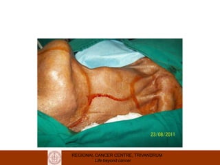 REGIONAL CANCER CENTRE, TRIVANDRUM
Life beyond cancer
 