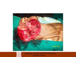 REGIONAL CANCER CENTRE, TRIVANDRUM
Life beyond cancer
 