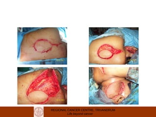 REGIONAL CANCER CENTRE, TRIVANDRUM
Life beyond cancer
 