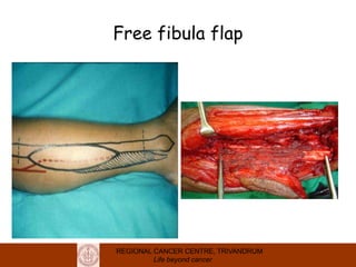 REGIONAL CANCER CENTRE, TRIVANDRUM
Life beyond cancer
Free fibula flap
 