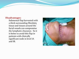 Disadvantages:
Submental flap harvested with
a thick surrounding fibrofatty
tissue and tissues around the
facial vessels can compromise
the lymphatic clearance. So it
is better to avoid this flap in
patients with clinically
significant node in level IA
and IB.
 