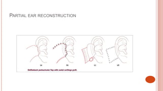 Ear Disintegration Reconstruction of ear | PPTX