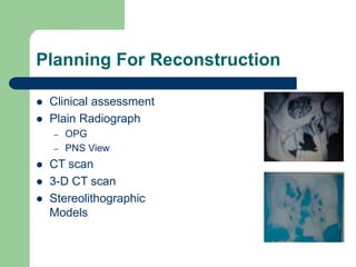 Planning For Reconstruction
 Clinical assessment
 Plain Radiograph
– OPG
– PNS View
 CT scan
 3-D CT scan
 Stereolithographic
Models
 