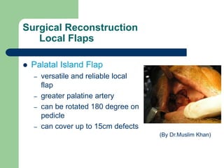 Surgical Reconstruction
Local Flaps
 Palatal Island Flap
– versatile and reliable local
flap
– greater palatine artery
– can be rotated 180 degree on
pedicle
– can cover up to 15cm defects
(By Dr.Muslim Khan)
 