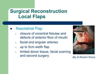 Surgical Reconstruction
Local Flaps
 Nasolabial Flap
– closure of oroantral fistulae and
defects of anterior floor of mouth
– facial and angular arteries
– up to 5cm width flap
– limited donor tissue, facial scarring
and second surgery (By Dr.Muslim Khan)
 