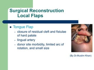 Surgical Reconstruction
Local Flaps
 Tongue Flap
– closure of residual cleft and fistulae
of hard palate
– lingual artery
– donor site morbidity, limited arc of
rotation, and small size
(By Dr.Muslim Khan)
 