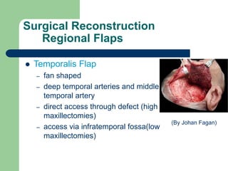 Surgical Reconstruction
Regional Flaps
 Temporalis Flap
– fan shaped
– deep temporal arteries and middle
temporal artery
– direct access through defect (high
maxillectomies)
– access via infratemporal fossa(low
maxillectomies)
(By Johan Fagan)
 