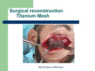 Surgical reconstruction
Titanium Mesh
(By Dr.Atta-ur-Rehman)
 