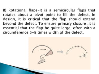 B) Rotational flaps-It is a semicircular flaps that
rotates about a pivot point to fill the defect. In
design, it is critical that the flap should extend
beyond the defect. To ensure primary closure ,it is
essential that the flap be quite large, often with a
circumference 5-8 times width of the defect.
 