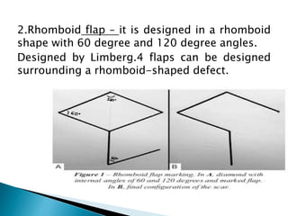 2.Rhomboid flap – it is designed in a rhomboid
shape with 60 degree and 120 degree angles.
Designed by Limberg.4 flaps can be designed
surrounding a rhomboid-shaped defect.
 