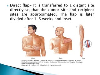  Direct flap- It is transferred to a distant site
directly so that the donor site and recipient
sites are approximated. The flap is later
divided after 1-3 weeks and inset.
 