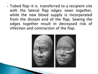  Tubed flap-it is transferred to a recipient site
with the lateral flap edges sewn together,
while the new blood supply is incorporated
from the distant end of the flap. Sewing the
edges together result in decreased risk of
infection and contraction of the flap.
 
