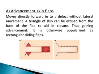 A) Advancement skin flaps
Moves directly forward in to a defect without lateral
movement. A triangle of skin can be excised from the
base of the flap to aid in closure. Thus gaining
advancement. It is otherwise popularized as
rectangular sliding flaps.
 