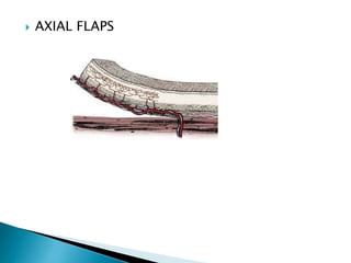  AXIAL FLAPS
 
