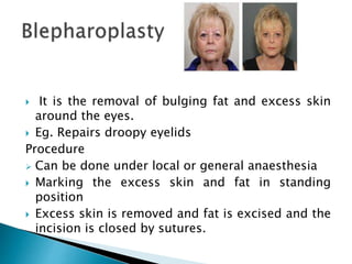  It is the removal of bulging fat and excess skin
around the eyes.
 Eg. Repairs droopy eyelids
Procedure
 Can be done under local or general anaesthesia
 Marking the excess skin and fat in standing
position
 Excess skin is removed and fat is excised and the
incision is closed by sutures.
 