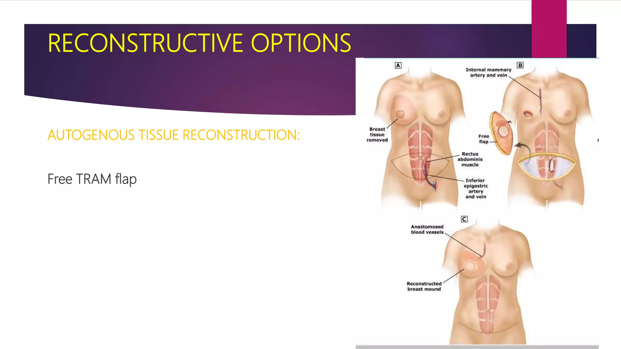 Reconstructive Breast Surgery PPTX reconstructive-breast-surgery-pptx