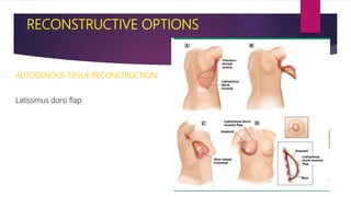 RECONSTRUCTIVE OPTIONS
AUTOGENOUS TISSUE RECONSTRUCTION:
Latissimus dorsi flap
 