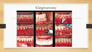 Gingivectomy
 