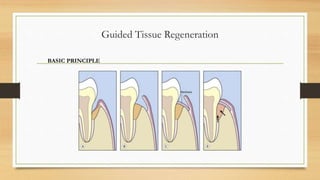 Guided Tissue Regeneration
BASIC PRINCIPLE
 