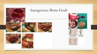 Autogenous Bone Graft
 