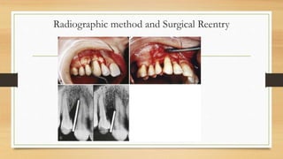Radiographic method and Surgical Reentry
 