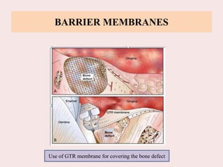 BARRIER MEMBRANES
Use of GTR membrane for covering the bone defect
 