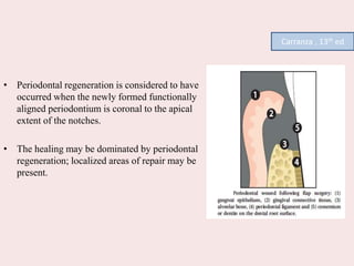 • Periodontal regeneration is considered to have
occurred when the newly formed functionally
aligned periodontium is coronal to the apical
extent of the notches.
• The healing may be dominated by periodontal
regeneration; localized areas of repair may be
present.
Carranza , 13th ed
 