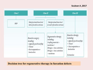 Decision tree for regenerative therapy in furcation defects
Sculean A ,2017
 