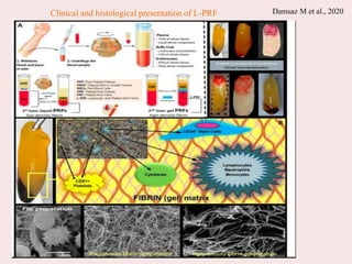 Damsaz M et al., 2020
Clinical and histological presentation of L-PRF
 