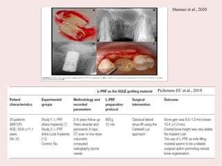 Pichotano EC et al., 2019
Damsaz et al., 2020
 