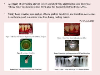 • A concept of fabricating growth factors-enriched bone graft matrix (also known as
“sticky bone”) using autologous fibrin glue has been demonstrated since 2010.
• Sticky bone provides stabilization of bone graft in the defect, and therefore, accelerates
tissue healing and minimizes bone loss during healing period.
Pai GP et al., 2020
 
