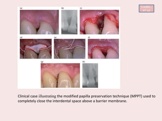 Clinical case illustrating the modified papilla preservation technique (MPPT) used to
completely close the interdental space above a barrier membrane.
Lindhe ,
6th ed
 