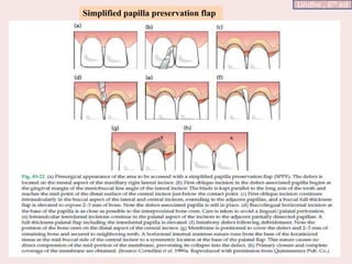 Simplified papilla preservation flap
Lindhe , 6th ed
 