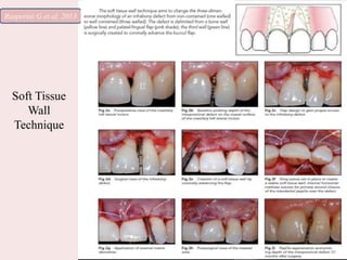 Soft Tissue
Wall
Technique
Rasperini G et al. 2013
 