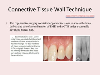 Connective Tissue Wall Technique
• The regenerative surgery consisted of palatal incisions to access the bony
defects and use of a combination of EMD and a CTG under a coronally
advanced buccal flap.
Zucchelli et al. 2017
 