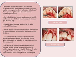 1.After local anesthesia, horizontal split-thickness
incisons were made at the base of the palatal anatomical
papillae covering the intrabony defects and at the base of
the two palatal papillae of the interdental spaces
neighboring the defects.
2. The palatal incisions were beveledas much as possible
in relation to the palatal soft tissue thickness to elevate a
split-thickness flap.
3.Once the palatal bone was reached, flap elevation
continued full thickness.
4.Similar split thickness incisions were made at the base of
the palatal papillae of the interdental spaces neighboring
the defect.
5.The supracrestal soft tissue was separated from the
palatal bone with a horizontal split-thickness incision
&then pushed from the palatal to the buccal aspect below
the contact point.
6. The buccal flap was raised with submarginal split-
thickness surgical papillae at the interdental spaces
neighboring the defect area, while full-thickness elevation
was performed to complete buccal elevation of the
supracrestal soft tissue coming from the palatal aspect.
Buccal view
Palatal view
 
