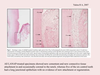 Yukna R A, 2007
All LANAP-treated specimens showed new cementum and new connective tissue
attachment in and occasionally coronal to the notch, whereas five of the six control teeth
had a long junctional epithelium with no evidence of new attachment or regeneration.
 