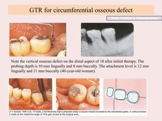 GTR for circumferential osseous defect
Note the vertical osseous defect on the distal aspect of 18 after initial therapy. The
probing depth is 10 mm lingually and 8 mm buccally. The attachment level is 12 mm
lingually and 11 mm buccally (40-year-old woman).
Sato, Naoshi: A Clinical Atlas
 