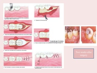 Two weeks after
surgery
 