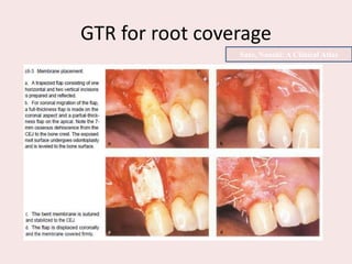 GTR for root coverage
Sato, Naoshi: A Clinical Atlas
 