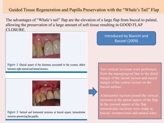 Guided Tissue Regeneration and Papilla Preservation with the “Whale’s Tail” Flap
Two vertical incisions were performed
from the mucogingival line to the distal
margin of the lateral incisor and mesial
margin of the central incisor on the
buccal surface .
A horizontal incision joined the vertical
incisions at the apical aspect of the flap.
In the coronal aspect of the flap
intrasulcular incisions were made at
buccal, interproximal and palatal sides.
The advantages of “Whale’s tail” flap are the elevation of a large flap from buccal to palatal,
allowing the preservation of a large amount of soft tissue resulting in GOOD FLAP
CLOSURE.
Introduced by Bianchi and
Basseti (2009)
 
